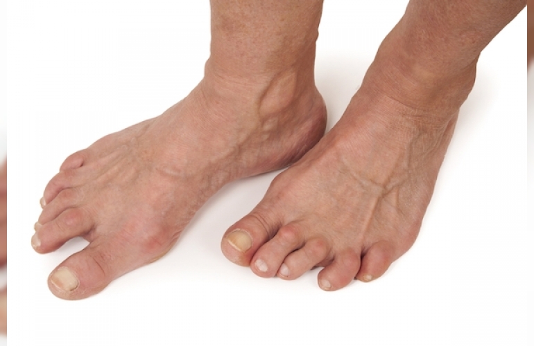 ayagin-veya-ayak-bileginin-romatoid-artriti