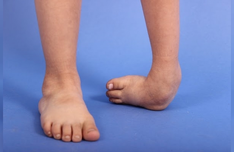 club-foot-deformitesi