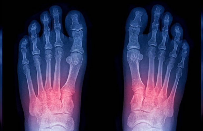 lisfranc