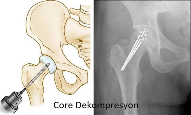 core-decompresion-kor-dekompresyon-ameliyatı