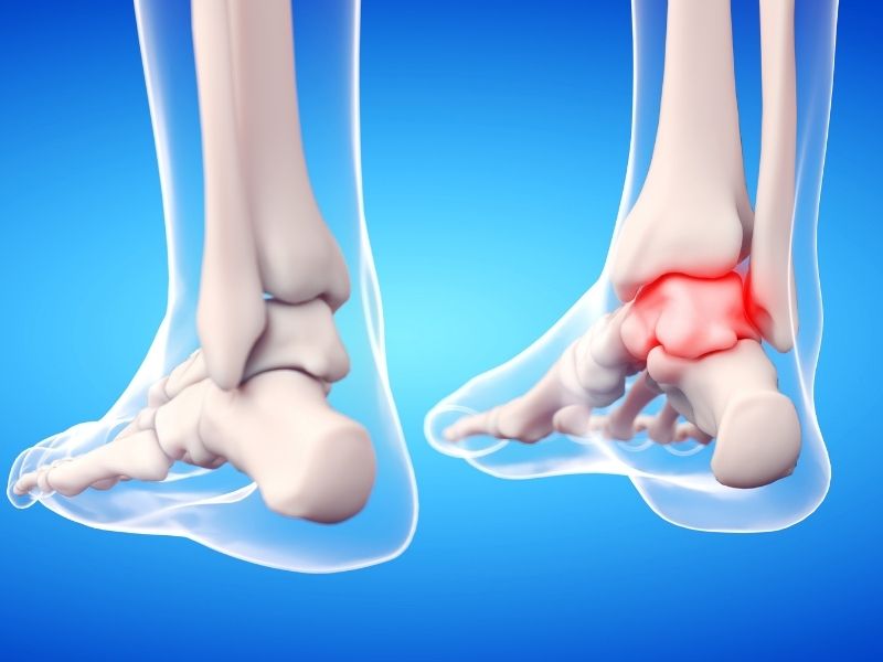 ayak-bilegi-teshis-artritler