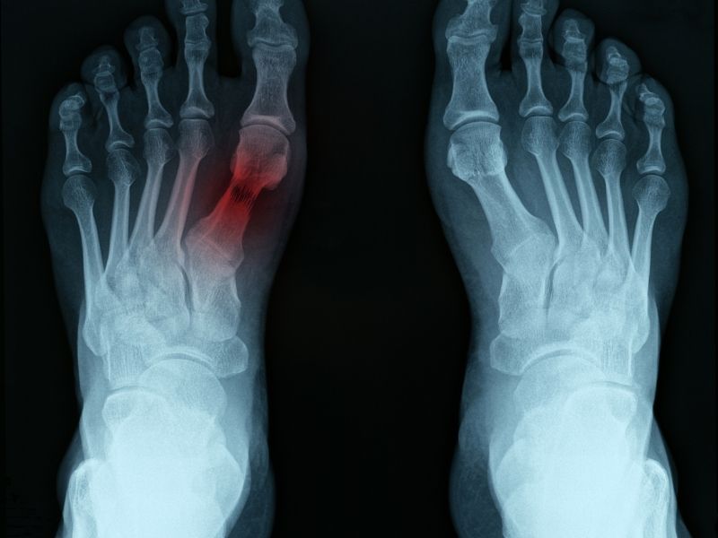 lisfranc