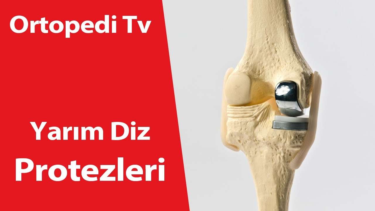deniz algün,ortopedi,ortopedik bilgi,ortopedi uzmanı,ortopedik,yarım diz protezi,diz protezi,Yarım Diz Protezleri,dr deniz algün,doktor,diz protezi markaları,diz protezi çeşitleri,diz protezi egzersizleri,diz protezi komplikasyonları,unikondiler