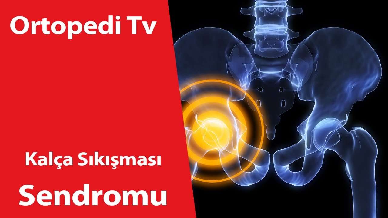 deniz algün,ortopedi,ortopedik bilgi,ortopedi uzmanı,ortopedik,Kalça Sıkışması Sendromu,kalça,Kalça Sıkışması,kalça tedavi,kalça ağrısı,doktor,dr deniz algün