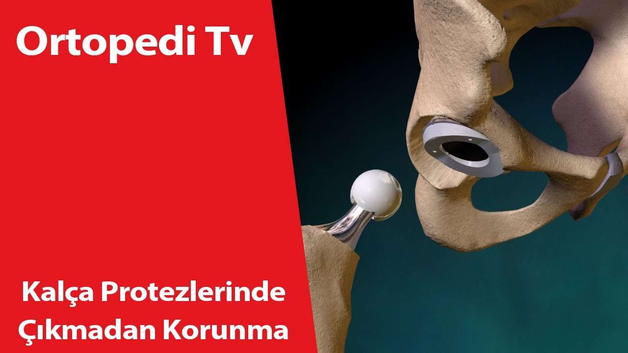 deniz algün,ortopedi,ortopedik bilgi,ortopedi uzmanı,ortopedik,Kalça Protezlerinde Çıkmadan Korunma,Kalça Protez,kalça protezi,protez,kalça,doktor,dr deniz algün