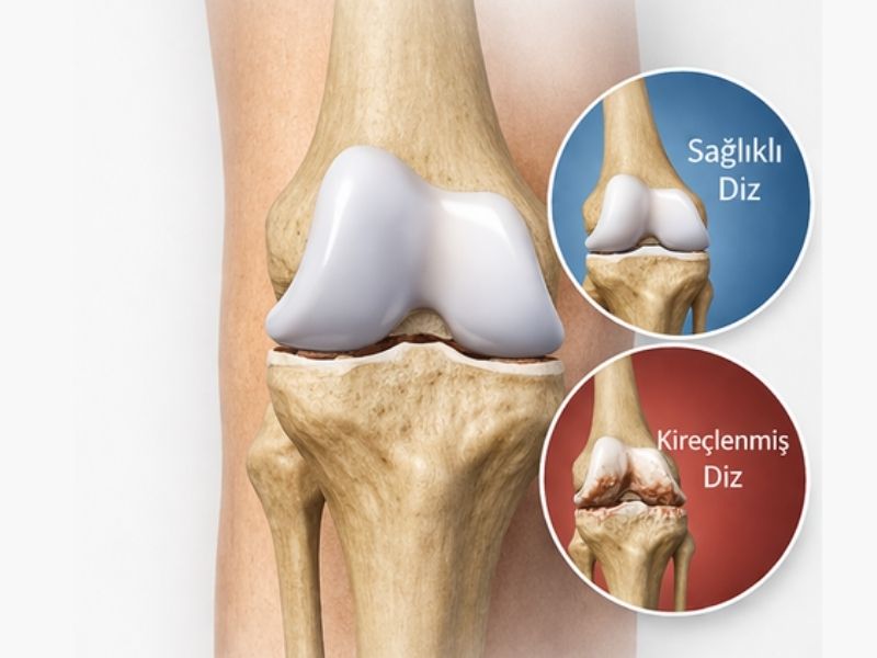 diz-protezi-hangi-hastaliklarda-kullanilir