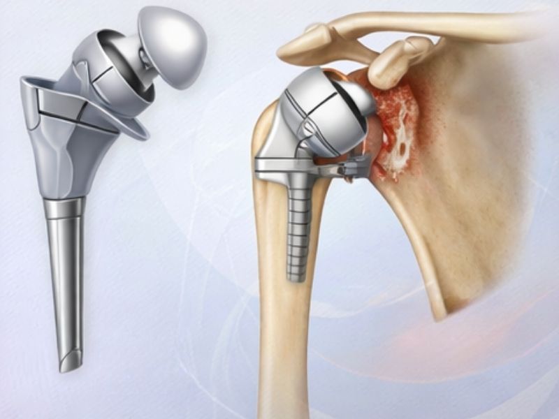 omuz-protezi-cesitleri-nelerdir