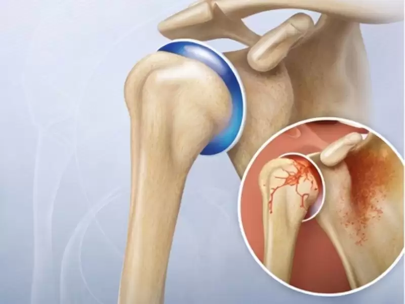 omuz-protezi-kimlere-uygulanir