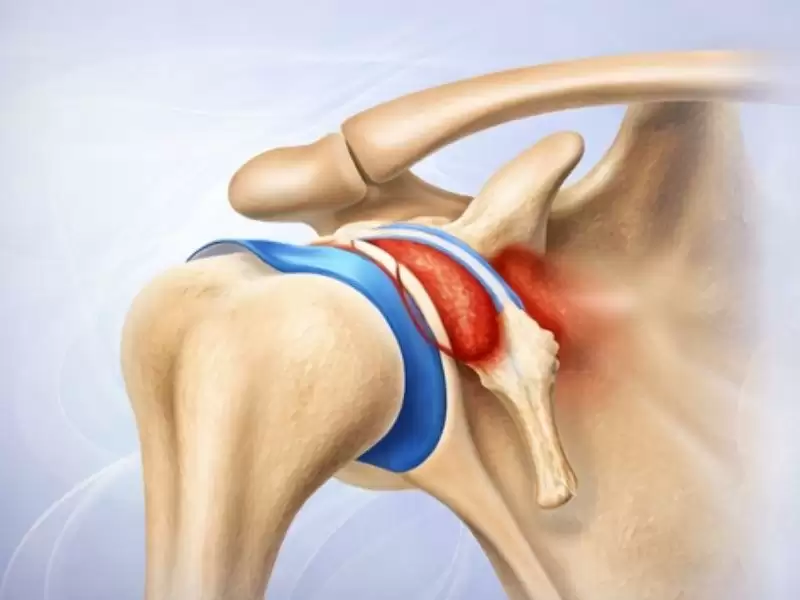 omuz-sikisma-sendromu-ameliyatsiz-duzelebilir-mi
